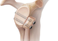 FAB 外科的摘出/Surgical Extraction Foil DYN FAB 外科的摘出/Surgical Extraction Foil DYN Surgical